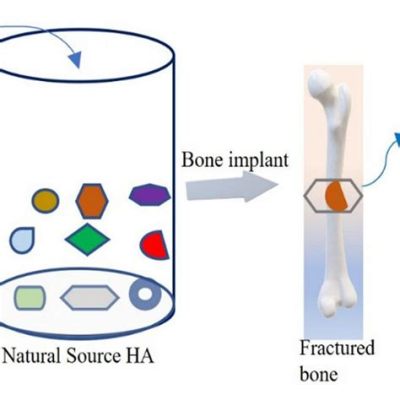 Hydroxyapatit i Benimplantat och Tandrestaurering – En Revolutionär Biomaterial för Klinisk Användning?